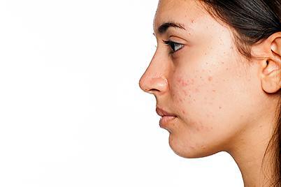 how-to-do-with-acne